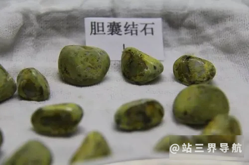 低成本治好胆结石 两款中药偏方助排石