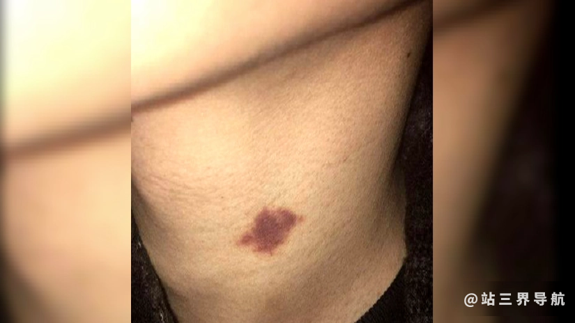 如何快速消除吻痕？